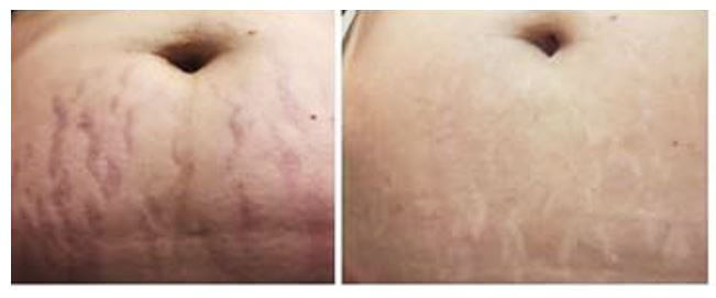 scar patch